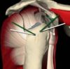 Suture