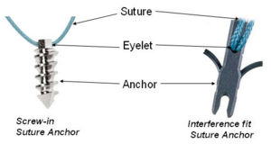 Suture design