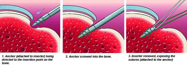 Suture achor mechanism.