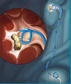 Contour injection ureteral stent.jpg