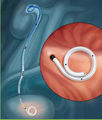 Polaris ultra ureteral stent.jpg