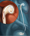 Retromax plus endopyelotomy stent.jpg