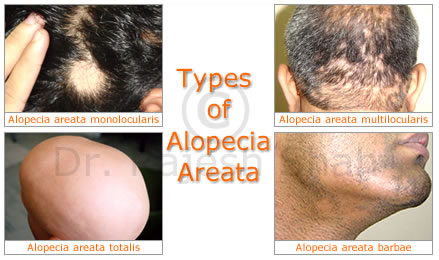 Types of alopecia areate.jpeg