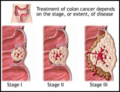 300px-Colon cancer.png